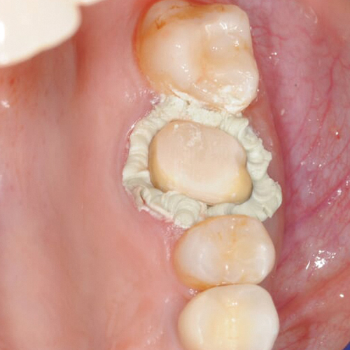 Access Edge being applied around the gingival sulcus