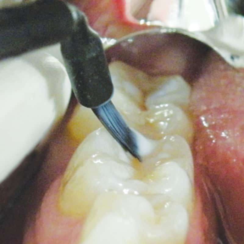 Champ Pit & Fissure Sealant being applied to tooth