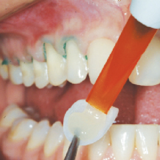 Connexio bonding agent being applied to tooth