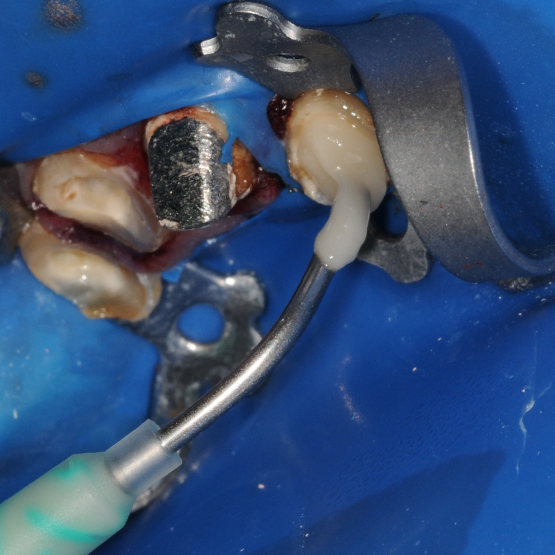 Encore D/C being used during procedure