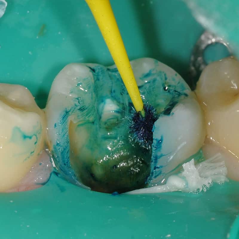 Exposé Caries Indicator being applied to tooth