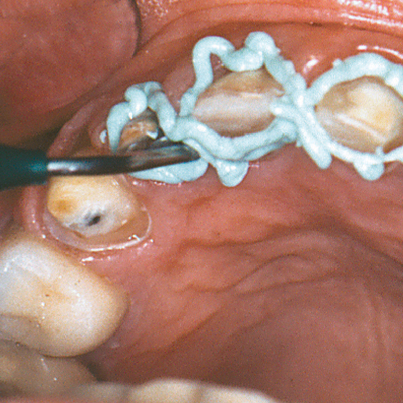 GingiTrac gingival retraction paste being applied to tooth