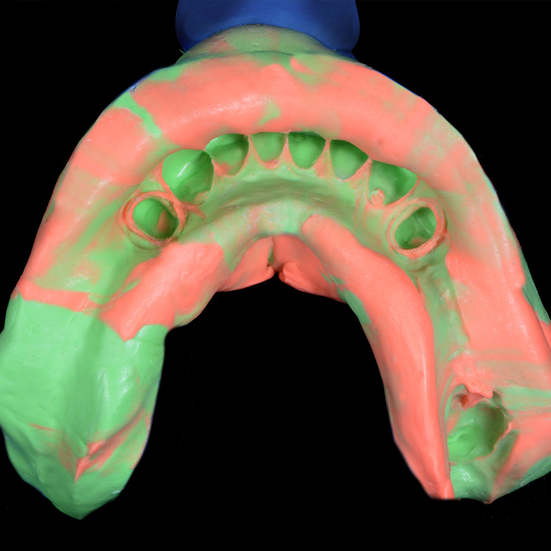 Impression of teeth made with NoCord VPS