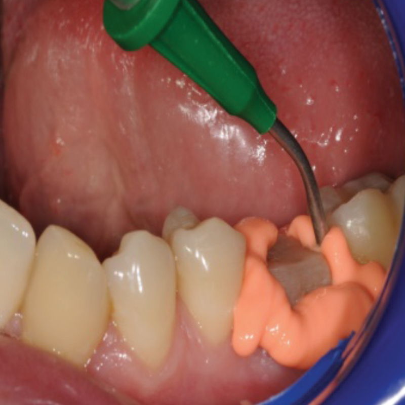 NoCord Wash Material being applied to tooth