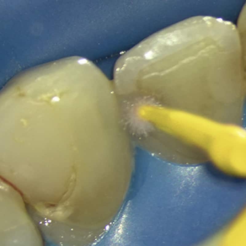 SilverSense SDF being applied to infected tooth