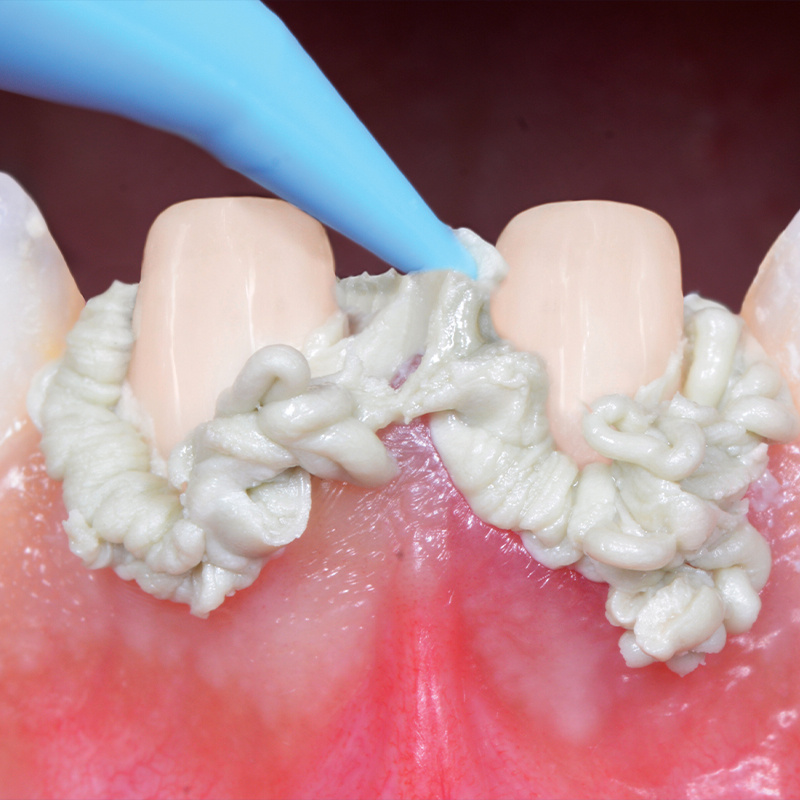 AccessFLO being applied to teeth