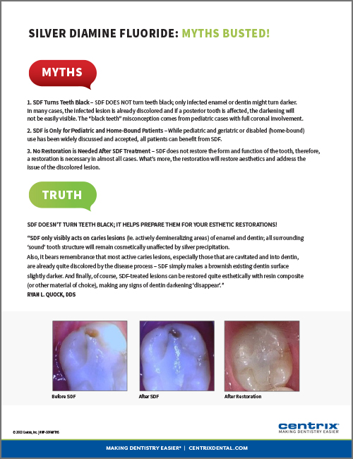 Silver Diamine Fluoride - Myths Busted!